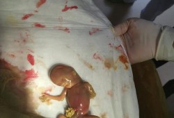 胎儿腹壁裂（胎儿腹壁裂）