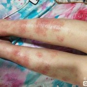 怀孕得了孕期湿疹要怎么办,孕期湿疹图片症状图片