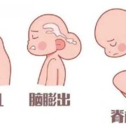胎儿脑膜脑膨出的原因（四维和B超的区别）
