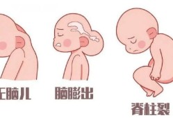 胎儿脑膜脑膨出的原因（四维和B超的区别）
