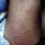 孕期能擦药吗（孕妇可以擦药吗？我被蚊子咬了，身上起了很大个包，想擦点药膏）
