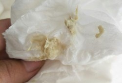 孕期白带发黄粘稠图片（怀孕了白带发黄是怎么回事）