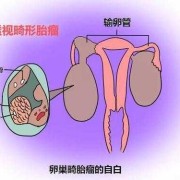 畸胎瘤到底是什么,胎儿畸胎瘤是怎么形成的原因