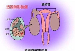 畸胎瘤到底是什么,胎儿畸胎瘤是怎么形成的原因