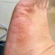怀孕期间脚痒怎么办（有没有怀孕之后脚特别痒的）