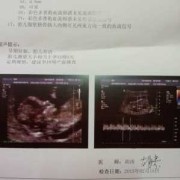 胎儿NT正常值是多少,胎儿NT值是什么意思