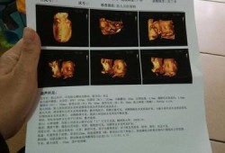 孕期四维彩超做几次（孕期四维彩超做几次合适）