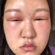 孕妇脸肿是什么原因,孕期脸水肿的原因造成的