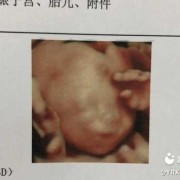 怀孕18周胎儿彩超（怀孕18周胎儿彩超图片）