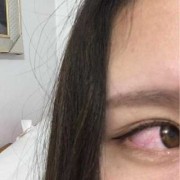 孕期眼睛疼（孕妇眼睛发炎怎么办）