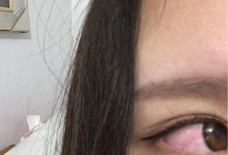 孕期眼睛疼（孕妇眼睛发炎怎么办）
