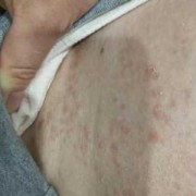 孕期肚皮湿疹（孕期肚子一块红的很痒）