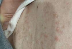 孕期肚皮湿疹（孕期肚子一块红的很痒）