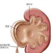 胎儿重度肾积水（胎儿重度肾积水生下来会怎样）