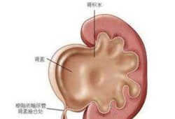 胎儿重度肾积水（胎儿重度肾积水生下来会怎样）