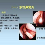 鼻窦炎对胎儿有影响吗（鼻窦炎对胎儿有影响吗）