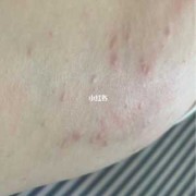 孕期湿疹注意什么（孕期湿疹注意什么）