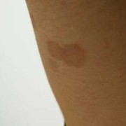 孕妇身上长了花斑癣怎么办,孕期长汗斑可以用药吗