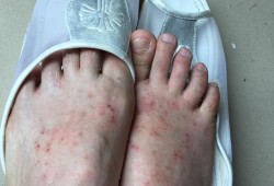 孕期脚面痒的难受（孕期脚面痒的难受怎么回事）