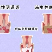 孕期搔痒（怀孕后外阴瘙痒咋回事？怎么办）