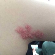 带状疱疹会对孕妇中的胎儿造成影响吗,胎儿畸形病毒有哪些