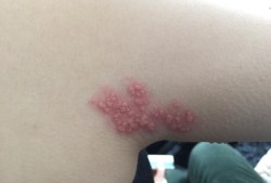 带状疱疹会对孕妇中的胎儿造成影响吗,胎儿畸形病毒有哪些
