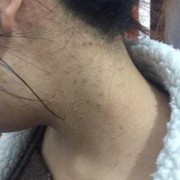 怀孕了能挤痘痘吗,孕期挤痘痘会影响胎儿发育吗