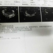 怀孕期间宫腔粘连带（怀孕期间宫腔粘连带怎么办）
