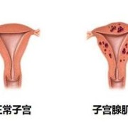 子宫充血是什么回事？需要怎样治疗,孕期子宫充血怎么办