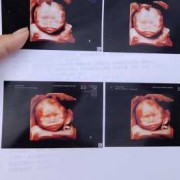 四维彩超兔唇怎么办,胎儿唇腭裂四维图片大全