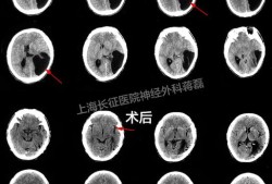 脑部囊肿严重吗,胎儿颅内囊肿是什么原因引起的
