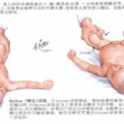 孕期阴阳腿是男宝吗（孕期阴阳腿孩子会有影响吗）