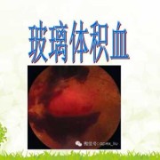 盆腔积血是怎么回事,孕期盆腔积血是怎么引起的