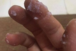 白带跟豆腐渣一样怎么回事,孕期白色豆腐渣分泌物