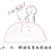 孕期乳头流