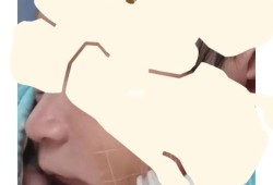 胎儿小下颚（宝宝平躺收下巴正确姿势）