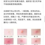 孕期长水痘怎么办（孕妇水痘要终止妊娠吗）