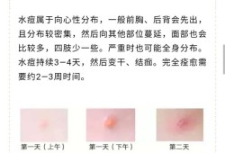 孕期长水痘怎么办（孕妇水痘要终止妊娠吗）