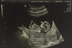 11周胎儿图男孩子（11周胎儿图男孩子b超图）