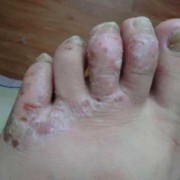 7岁孩子脚痒外部无任何特征,孕妇脚痒会影响胎儿吗视频