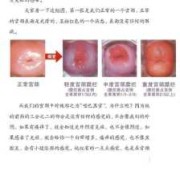 孕期宫颈糜烂出血（检查出宫颈糜烂三度，有接触性出血，请问怎么治疗）