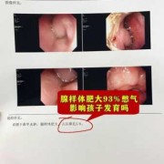 孕妇鼻炎对胎儿的影响（孕妇鼻炎对胎儿的影响大吗）