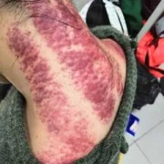 孕期能刮痧吗（孕期能刮痧吗脖子）