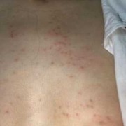 孕妇身上发痒是什么原因,孕期全身痒怎么回事儿