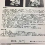 胎儿正常眼距（宝宝眼距离宽，其它没有发现什么）