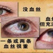 眼睛痒是怎么回事，眼睛痒是什么原因引起,孕期眼睛痒怎么办越揉越痒