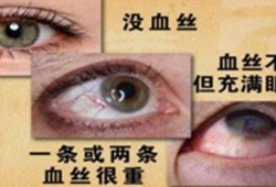 眼睛痒是怎么回事，眼睛痒是什么原因引起,孕期眼睛痒怎么办越揉越痒