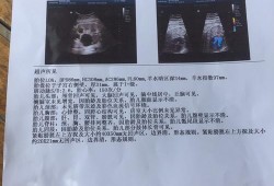 胎儿右侧囊肿（胎儿右侧囊肿是因为什么原因引起的）