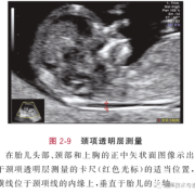 胎儿颈部可见u形压迹（怀孕37周胎儿检查颈项可见u型压迹是什么意思）