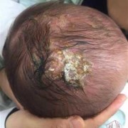 刚出生的小宝宝头部比较长，能不能恢复,胎儿头长得快怎么回事
